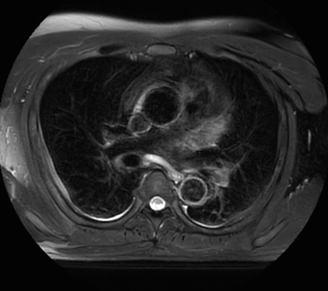 Axial MultiVane XD - T2w SPIR