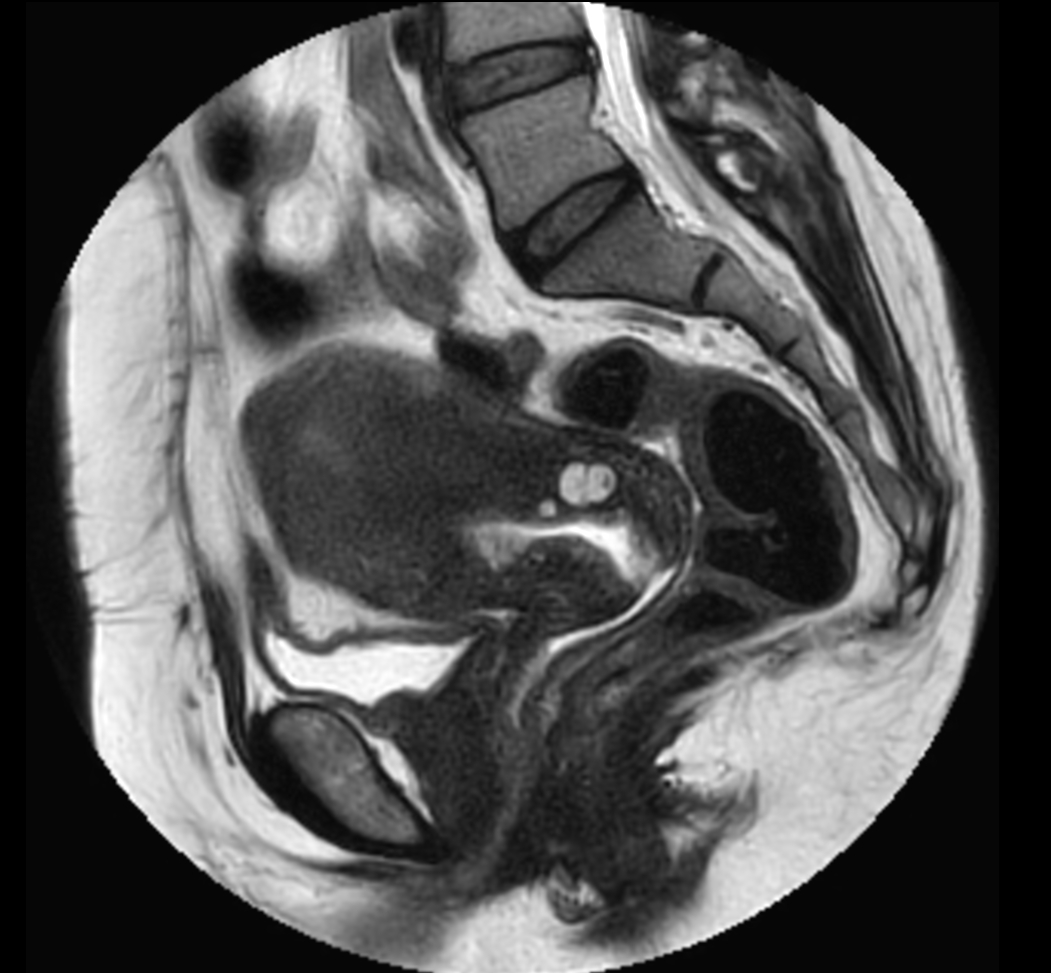 Sagittal MultiVane XD - T2w TSE