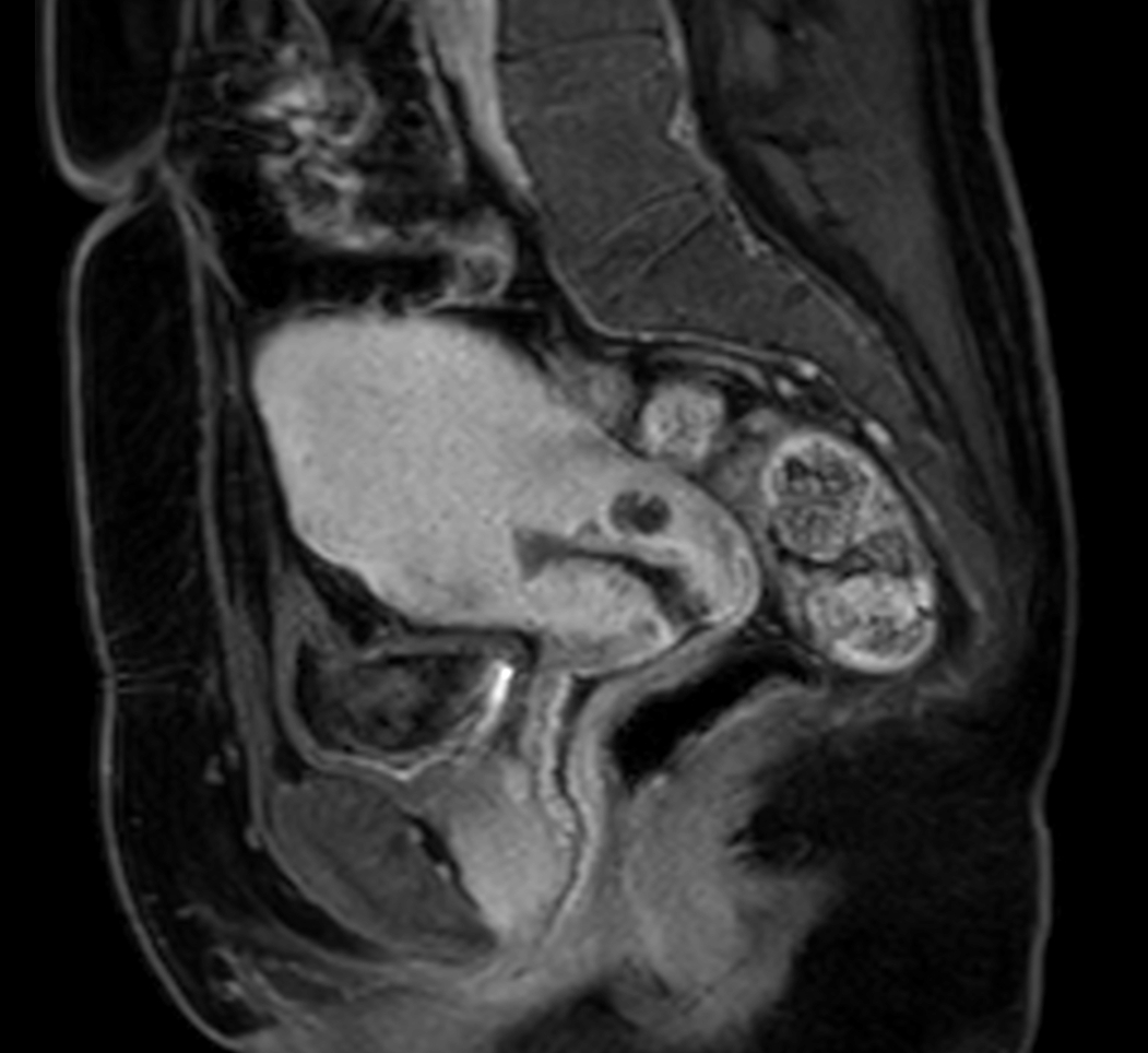 Sagittal mDIXON XD - T1w FFE plus gado (Water only)