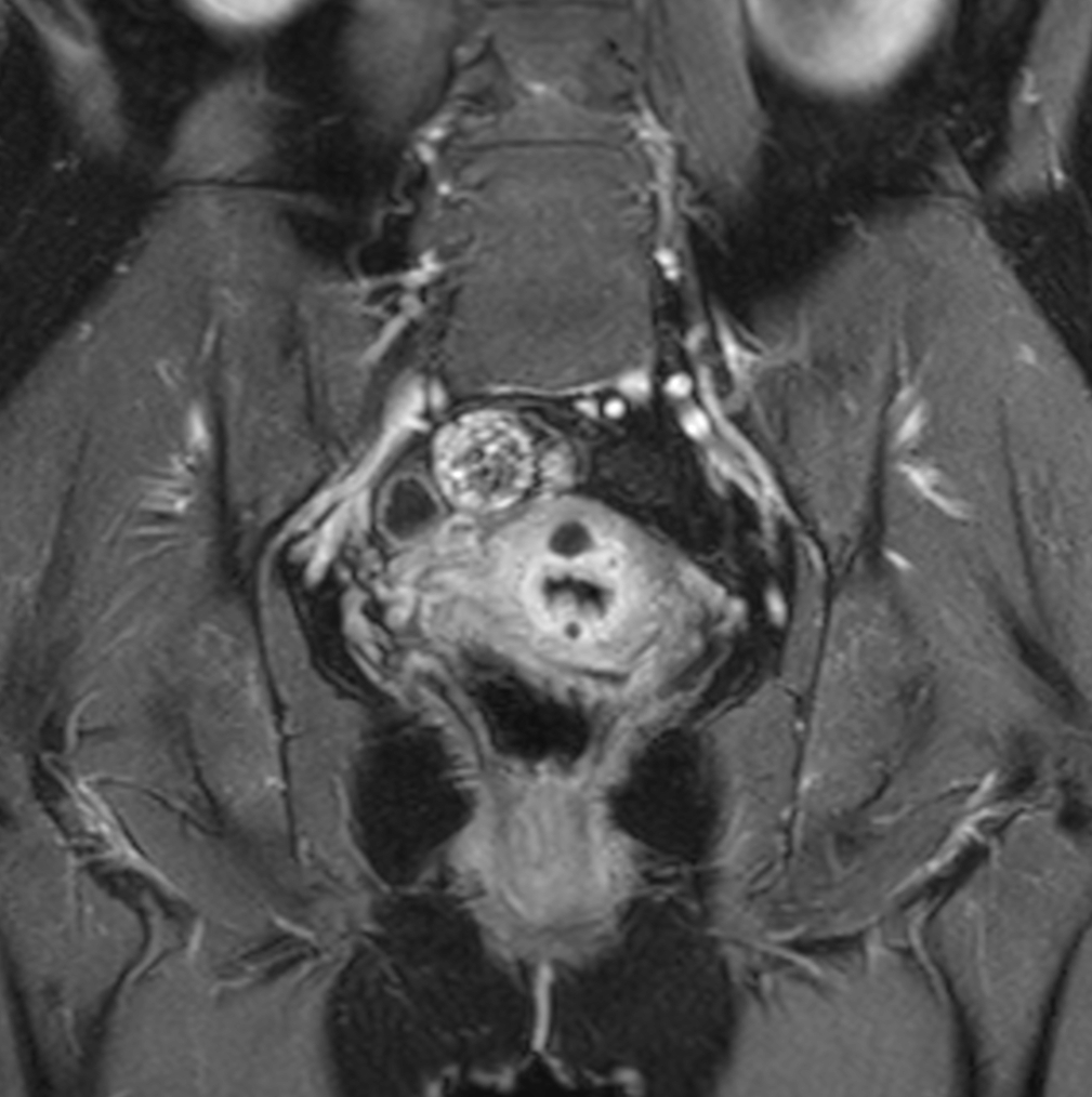 Coronal mDIXON XD - T1w FFE plus gado (Water only)