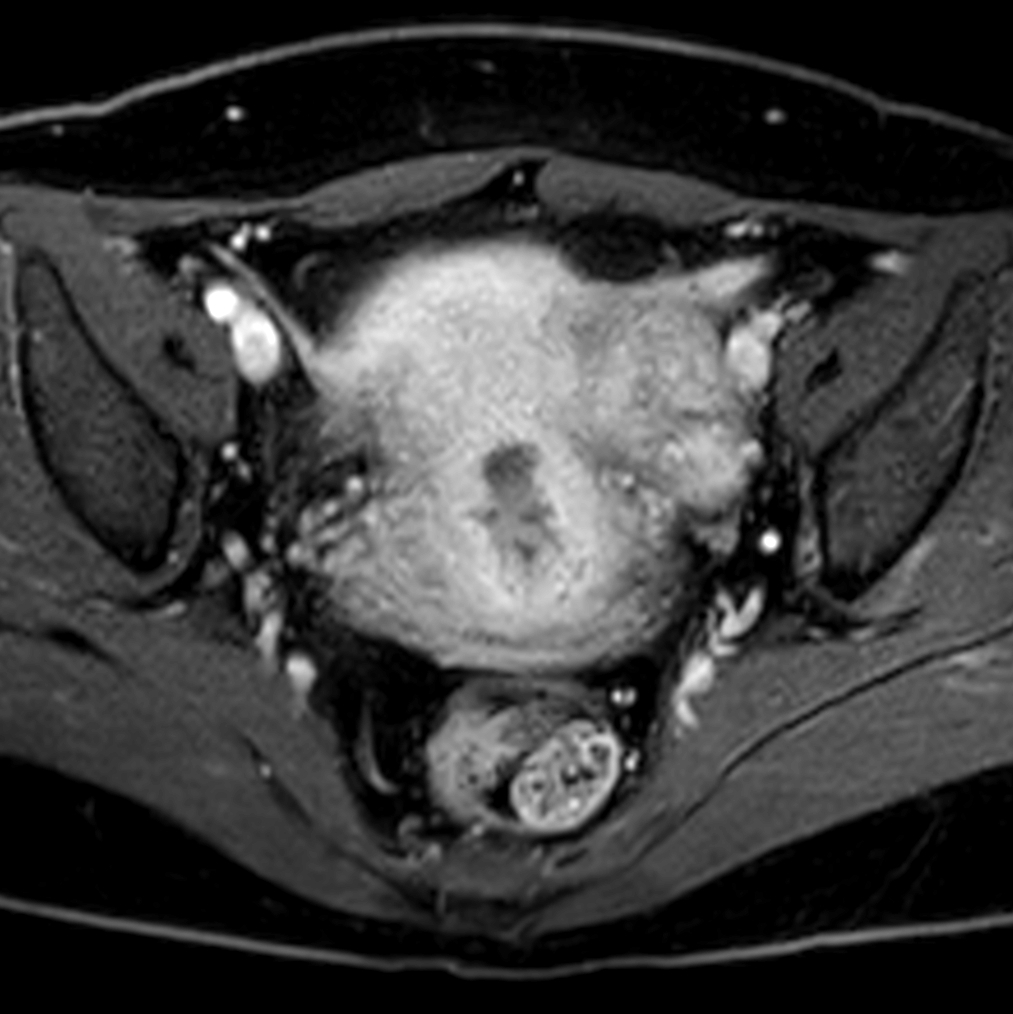 Axial mDIXON XD - T1w FFE plus gado (Water only)