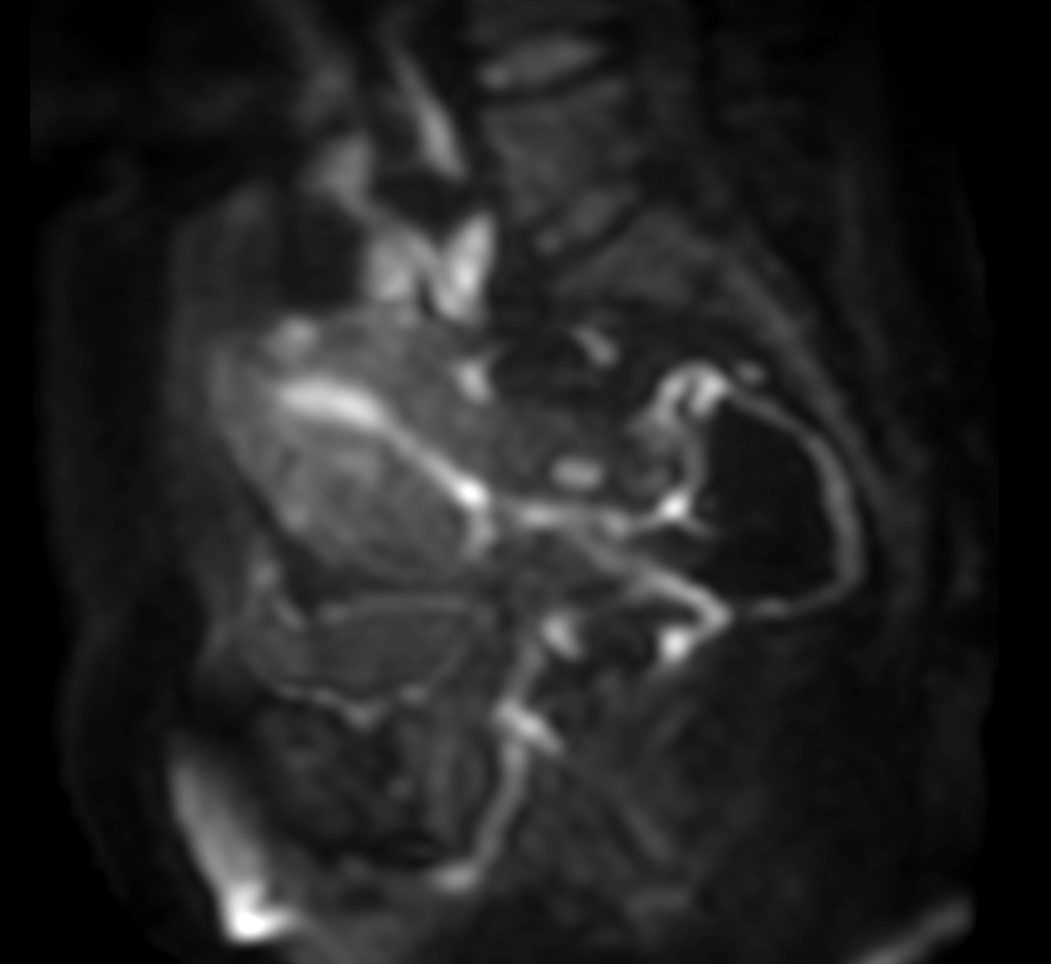 Sagittal DWI (b800)