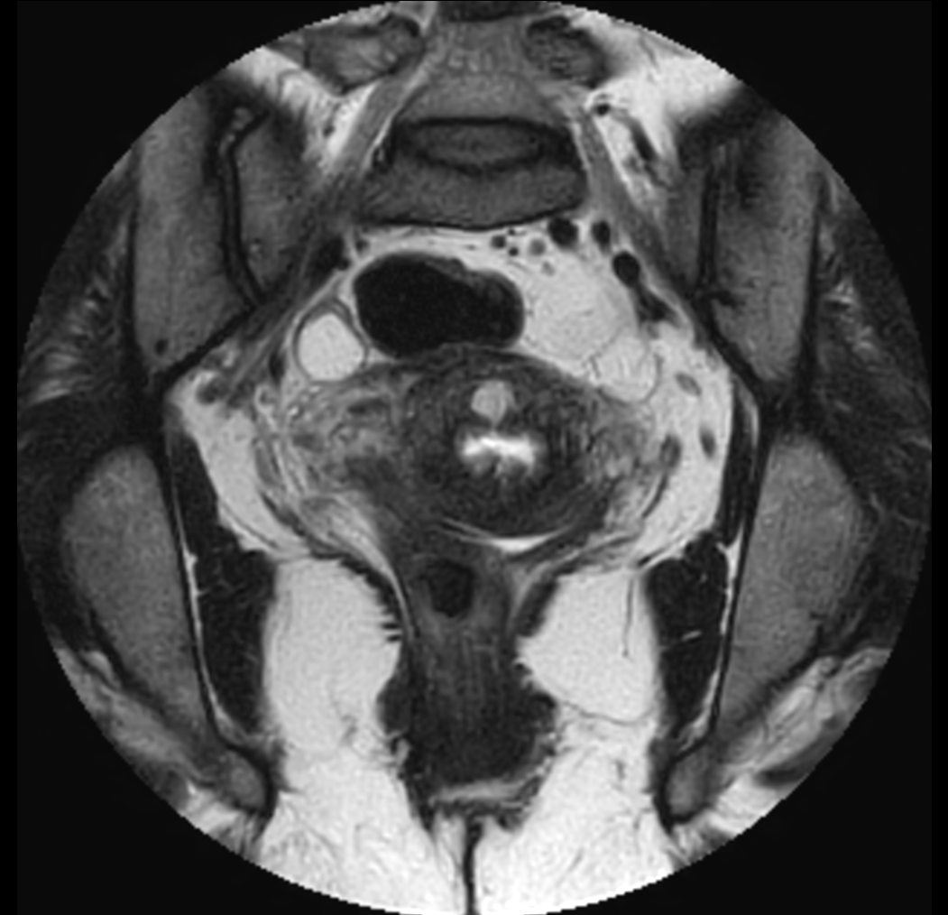 Coronal MultiVane XD - T2w TSE