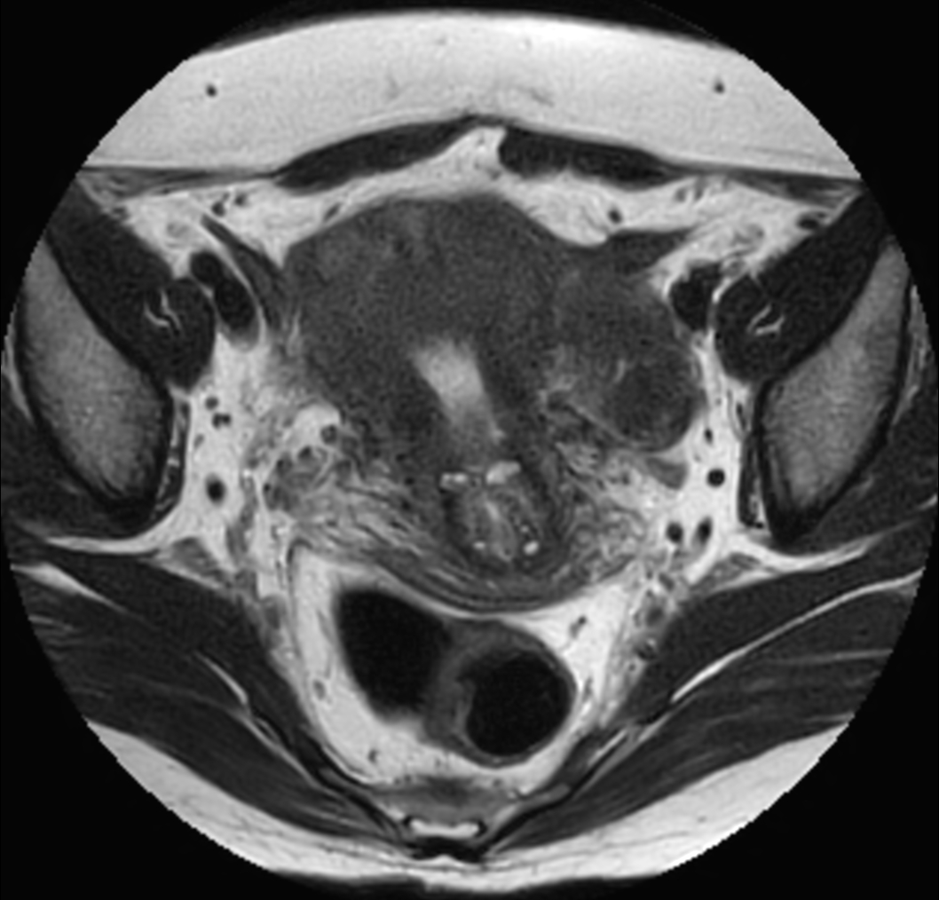 Axial MultiVane XD - T2w TSE