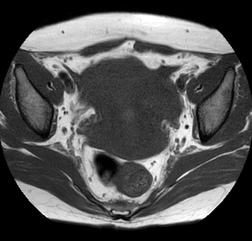 Axial MultiVane XD - T1w TSE