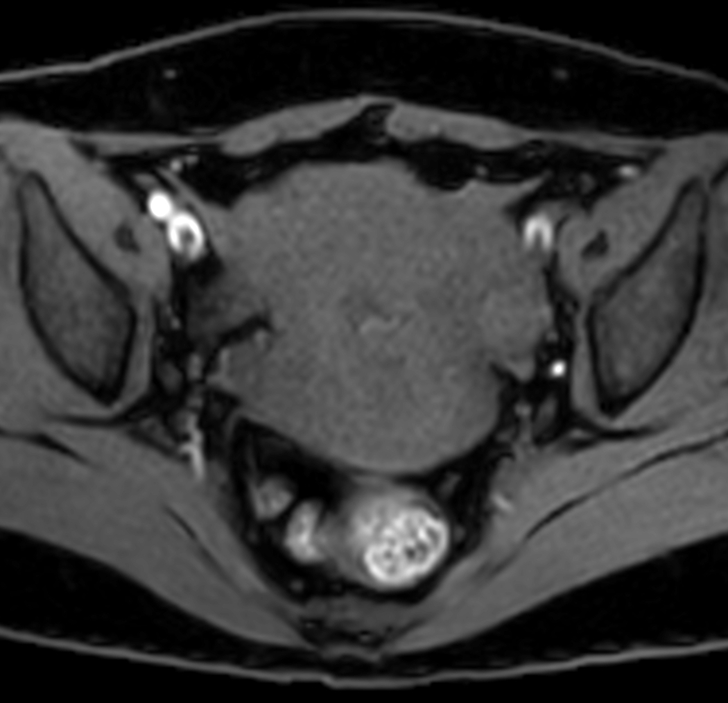 Axial mDIXON XD - T1w FFE (Water only)
