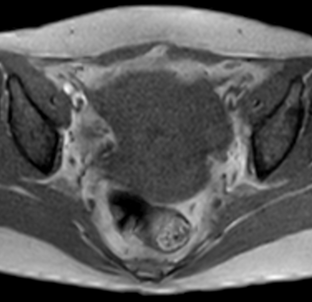 Axial mDIXON XD - T1w FFE (In Phase)