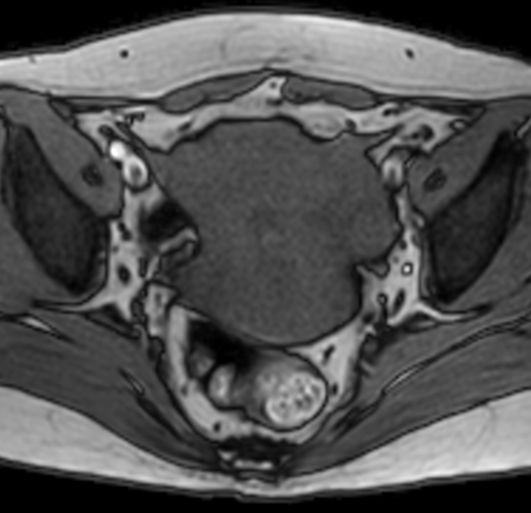 Axial mDIXON XD - T1w FFE (Out Phase)
