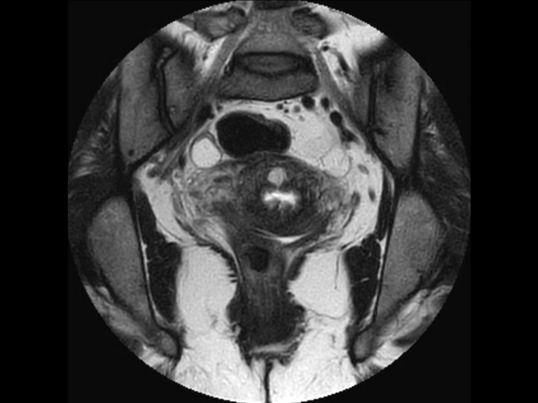 Coronal MultiVane XD - T2w TSE