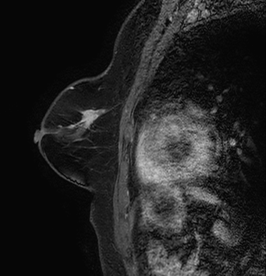 Sagittal eTHRIVE plus gado