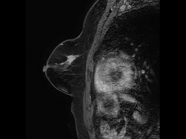 Sagittal eTHRIVE plus gado