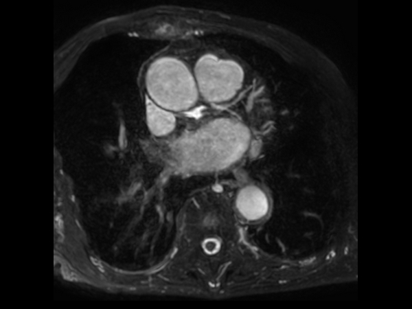 Coronaries - LCX