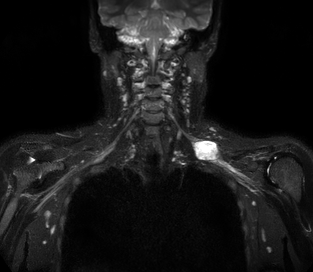 Coronal 3D STIR (MIP)
