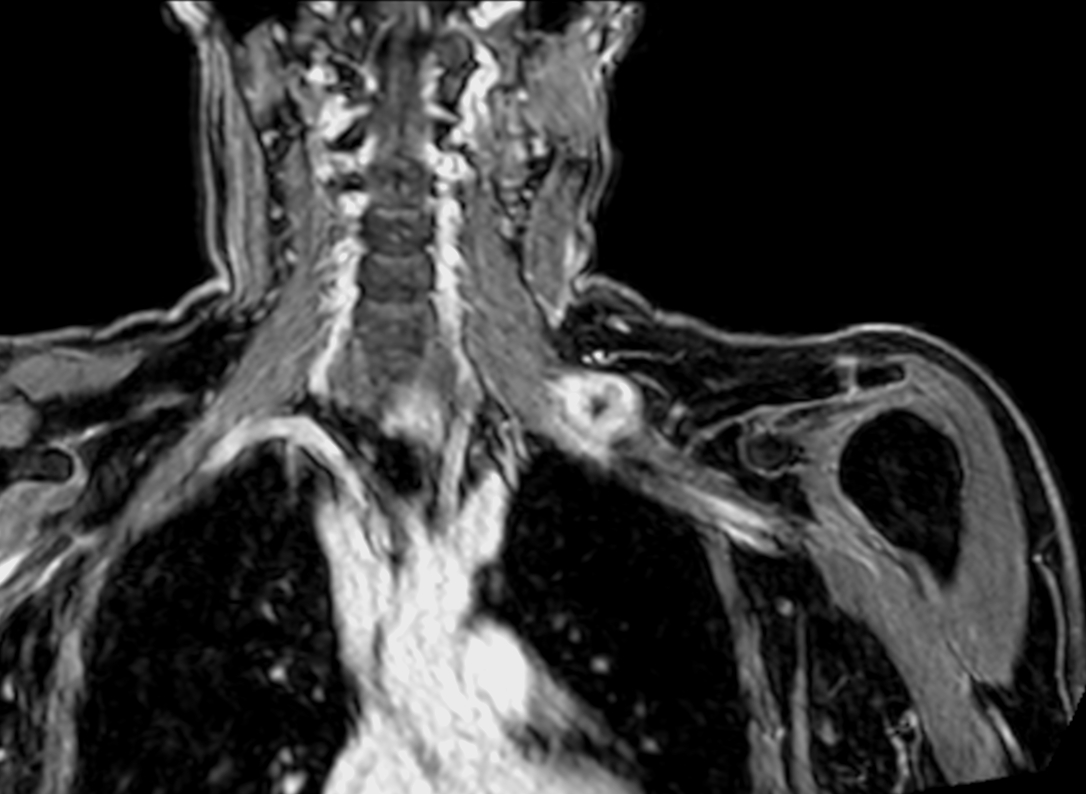 Coronal mDIXON XD - T1w FFE (Water only)