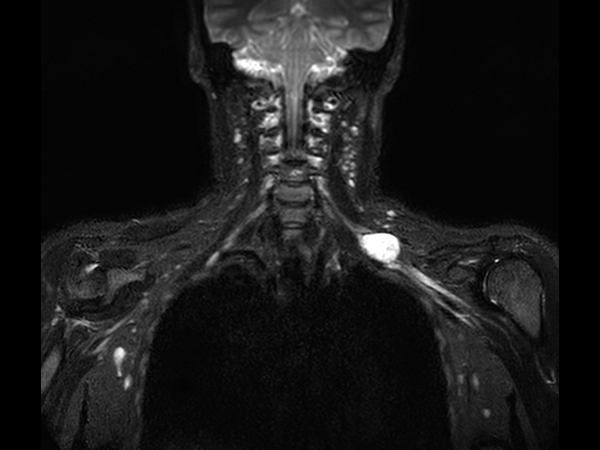 Coronal 3D STIR