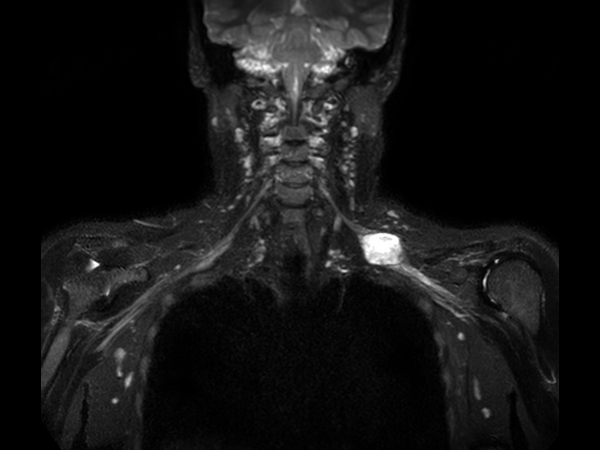 Coronal 3D STIR (MIP)