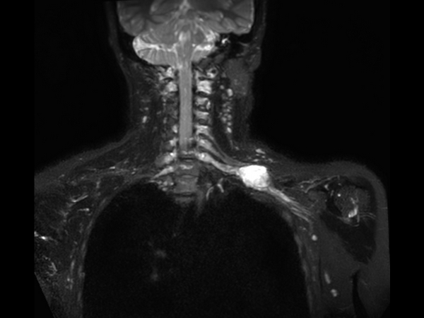 Coronal 3D STIR (oblique MIP)