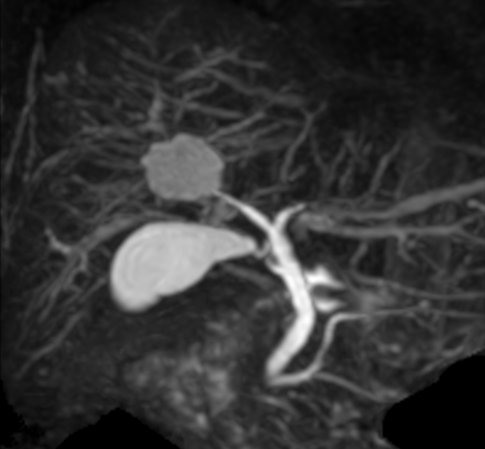 Coronal MRCP (GRASE, MIP)