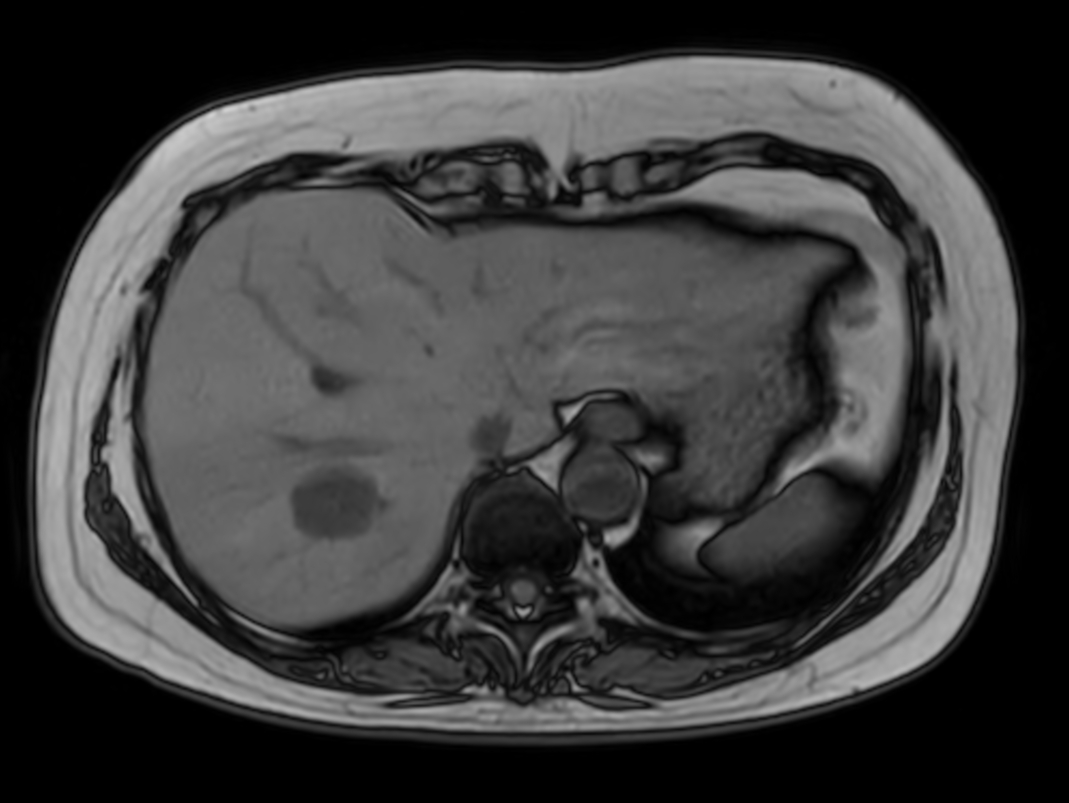 Axial mDIXON XD FFE (Out Phase)