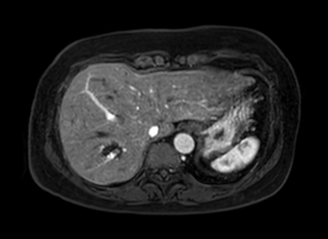 Axial eTHRIVE (2nd dynamic)