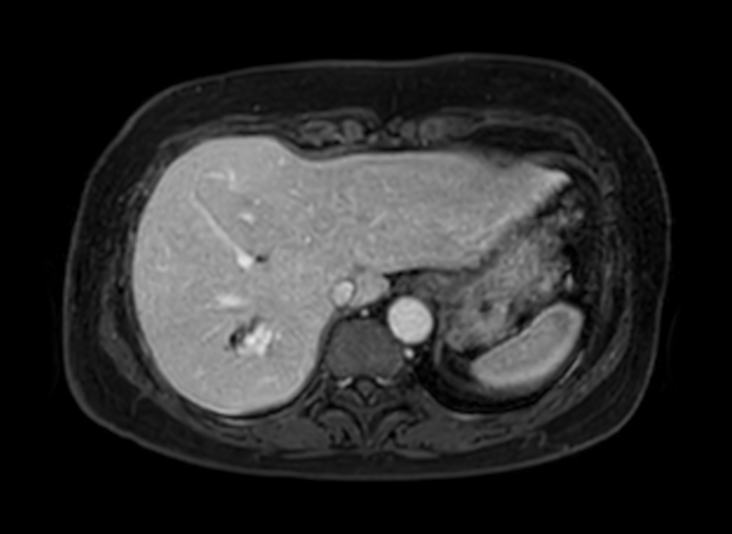 Axial eTHRIVE (4th dynamic)