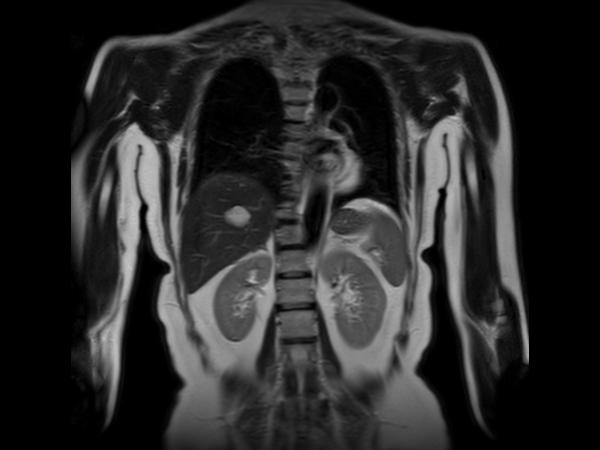 Coronal T2w SSh