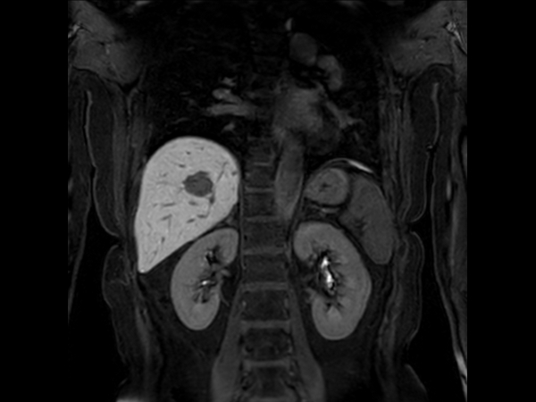 Coronal eTHRIVE 