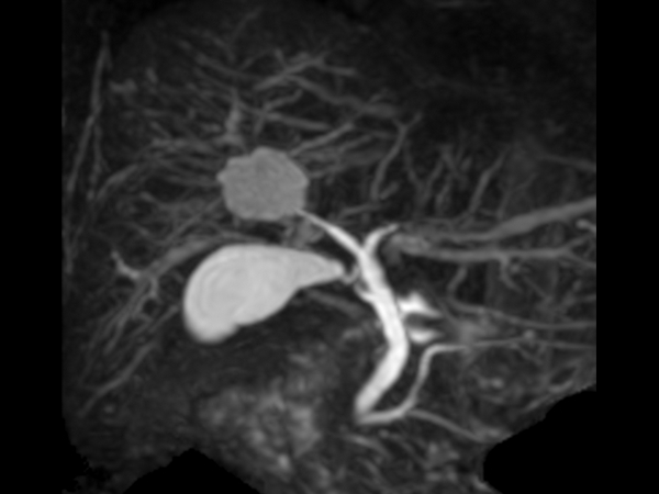 Coronal MRCP (GRASE, MIP)