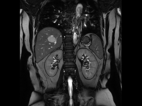 Coronal bTFE