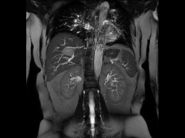 Coronal bTFE (MIP)