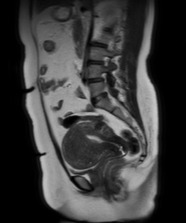 Sagittal T2w SSh