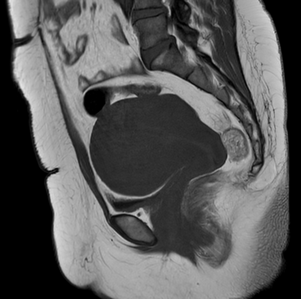 Sagittal T1w TSE