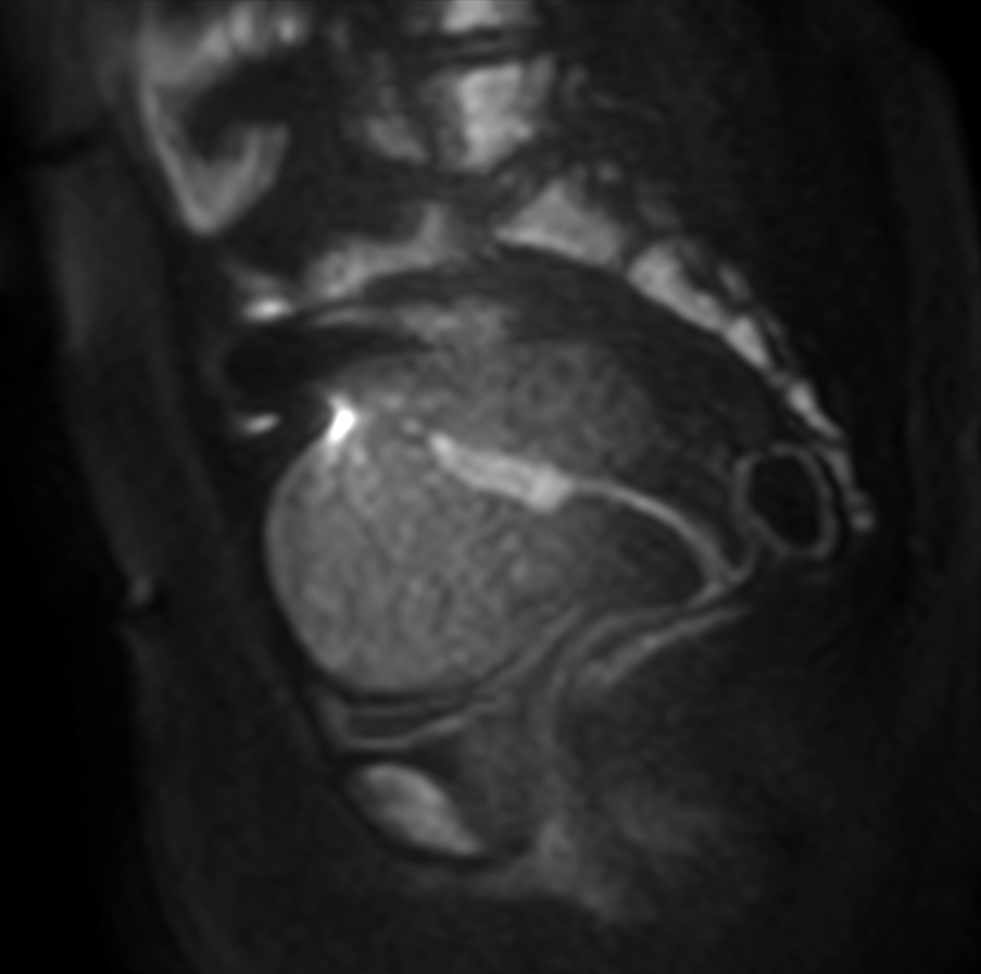 Sagittal DWI (b1000)