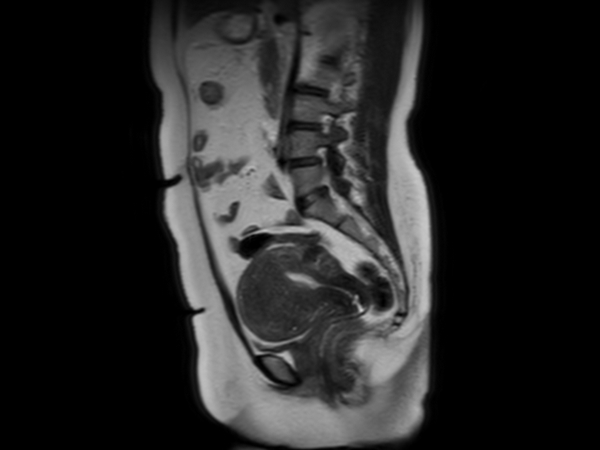 Sagittal T2w SSh