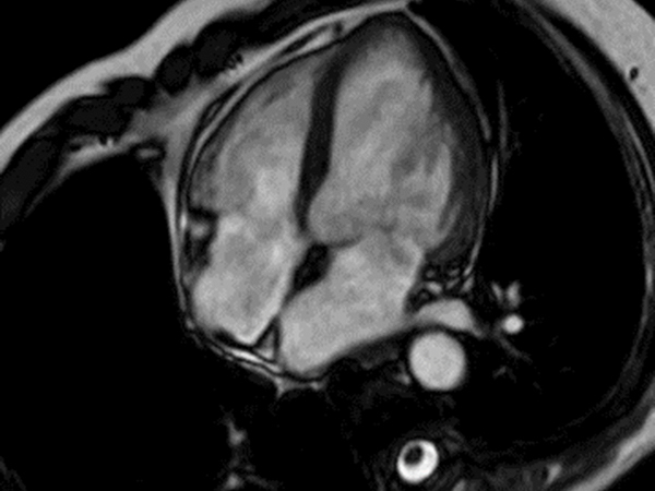 Cine - 4 chamber