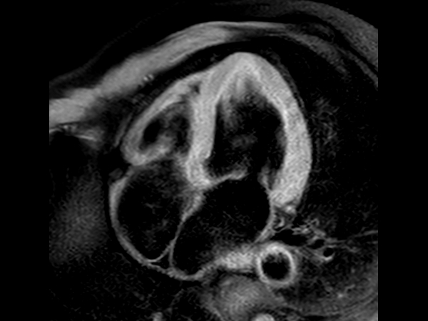 T1w FatSat Black Blood - 4 chamber