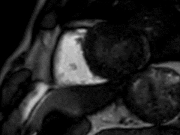 Cine Perfusion - Short axis