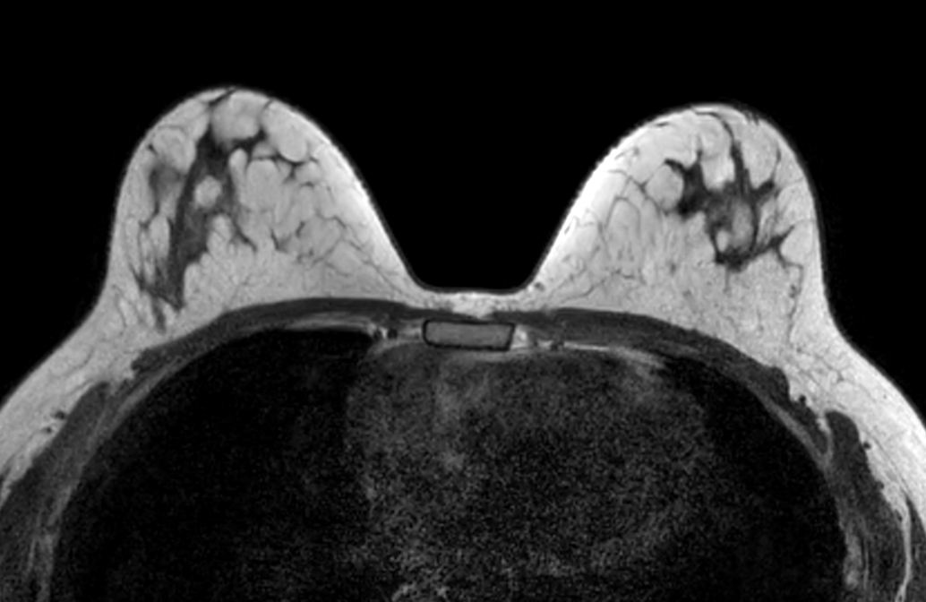 Axial mDIXON XD FFE (In Phase) - Dyn 1