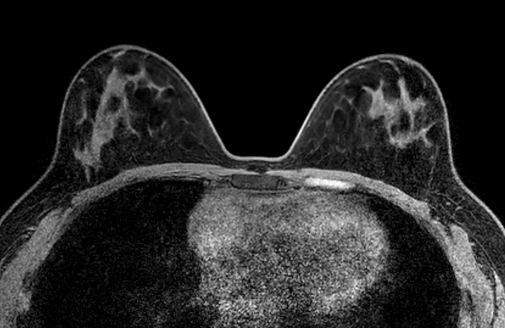 Axial mDIXON XD FFE (Water only) - Dyn 1