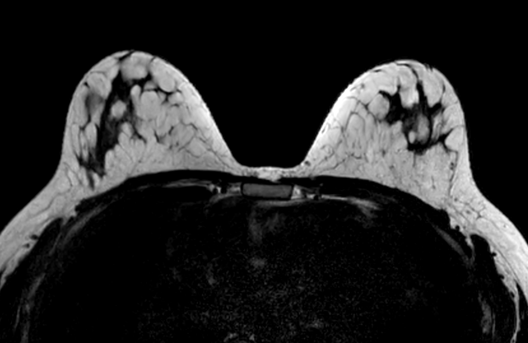 Axial mDIXON XD FFE (Fat only) - Dyn 1