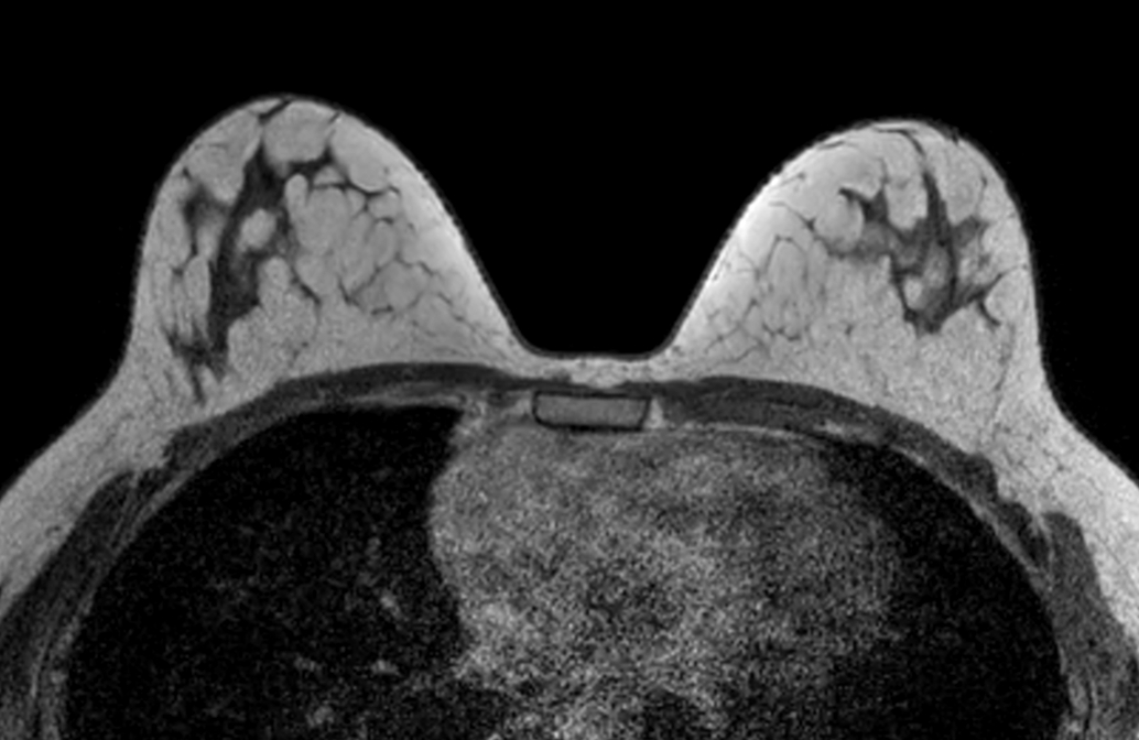 Axial mDIXON XD FFE (In Phase) - Dyn 4