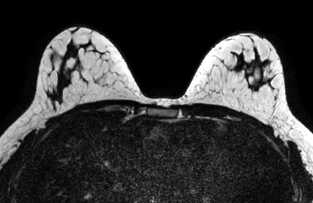 Axial mDIXON XD FFE (Fat only) - Dyn 4