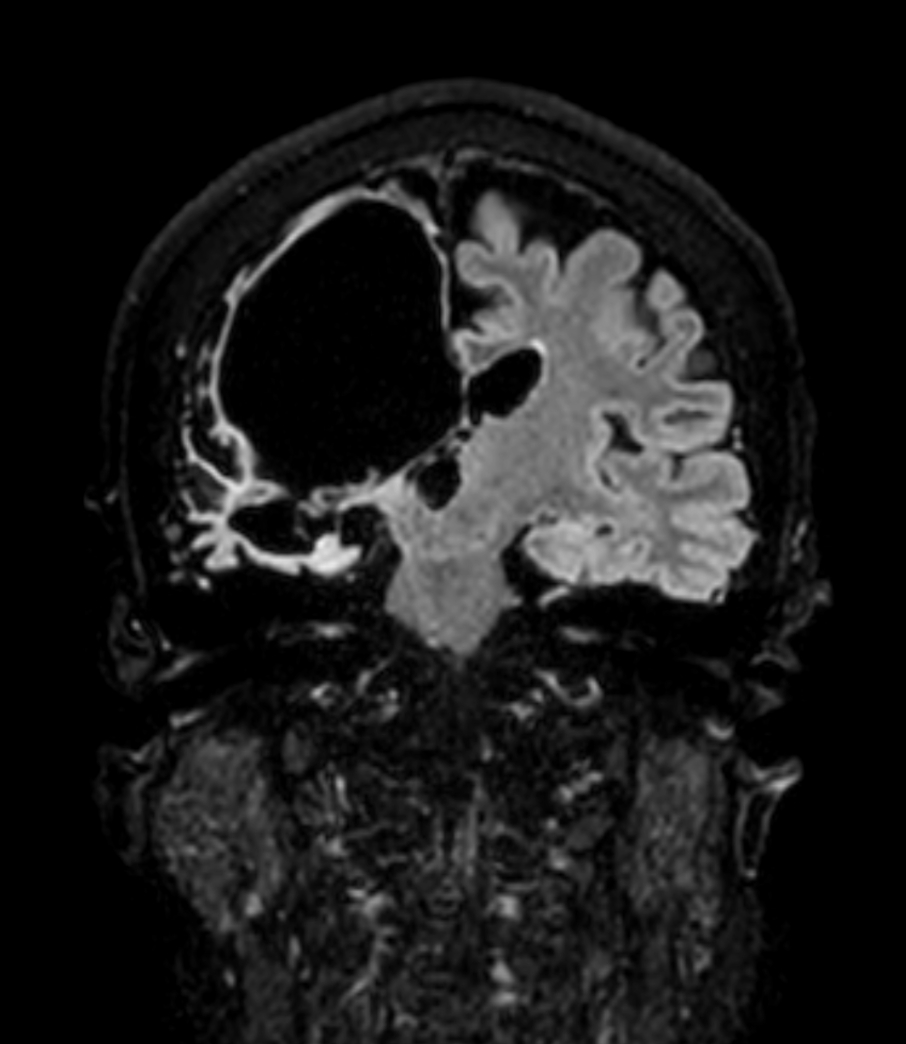 Coronal 3D BrainVIEW FLAIR (Compressed SENSE)