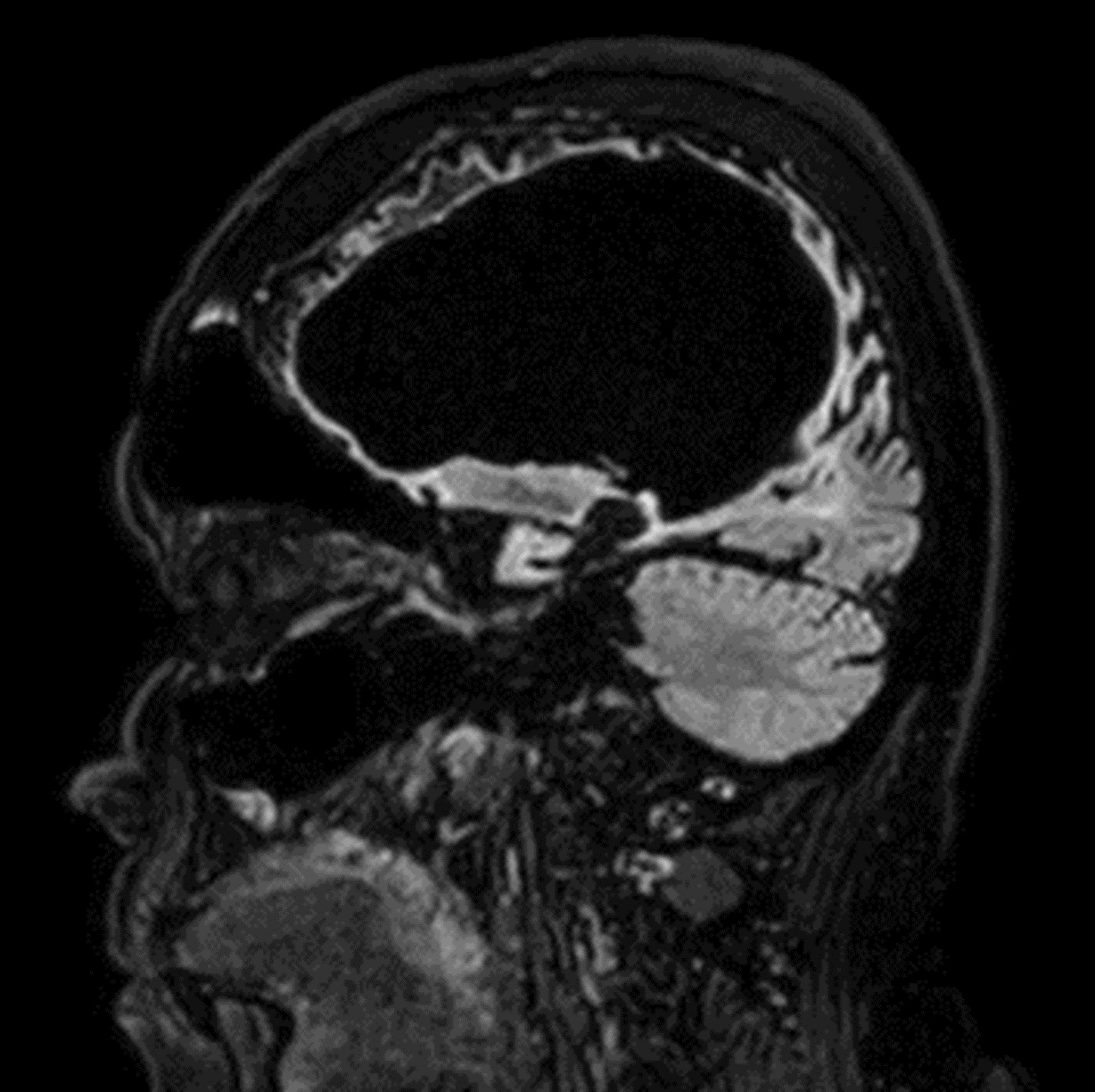 Sagittal 3D BrainVIEW FLAIR (without Compressed SENSE)