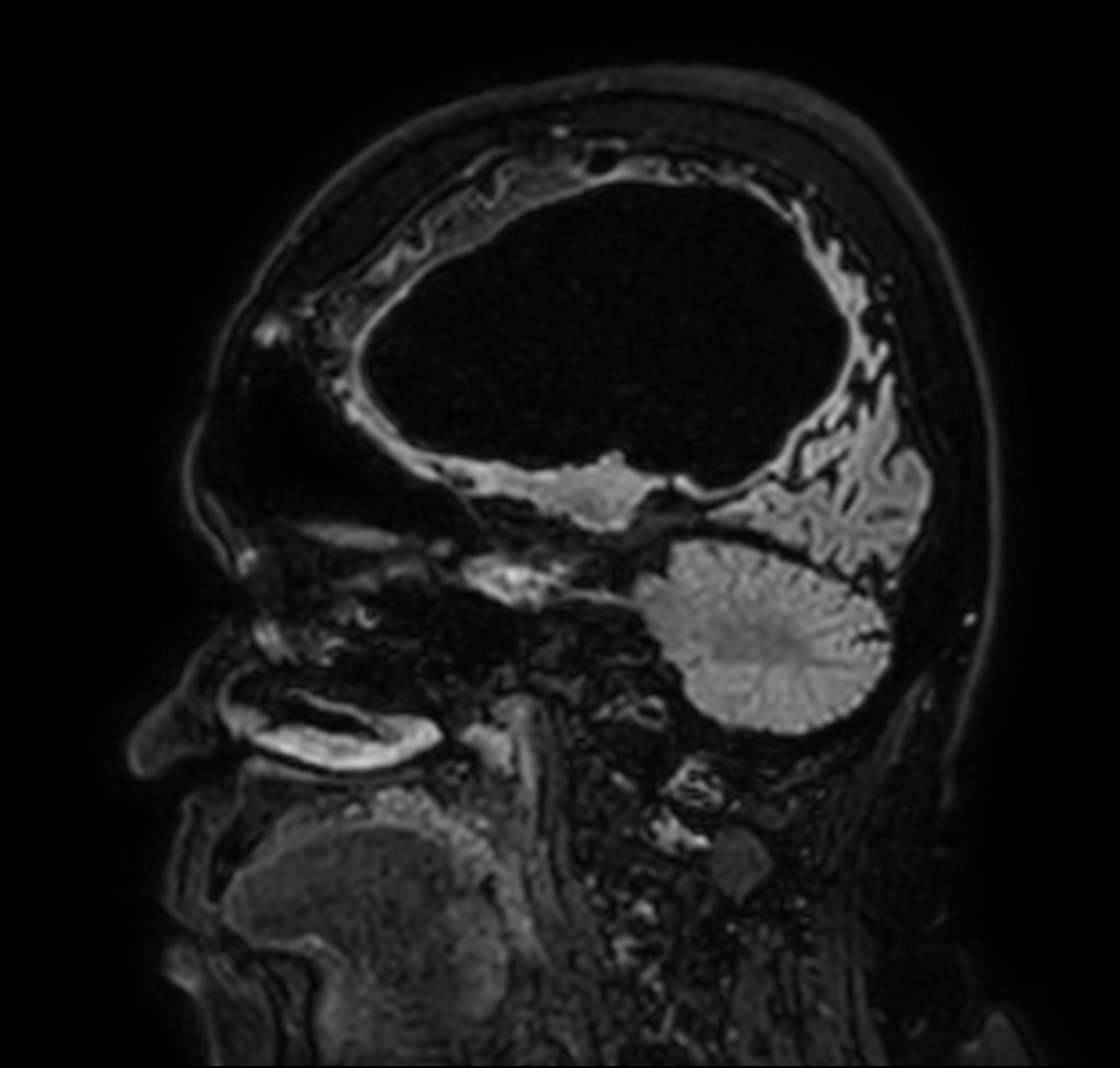 Sagittal 3D BrainVIEW FLAIR (Compressed SENSE)<p> </p>