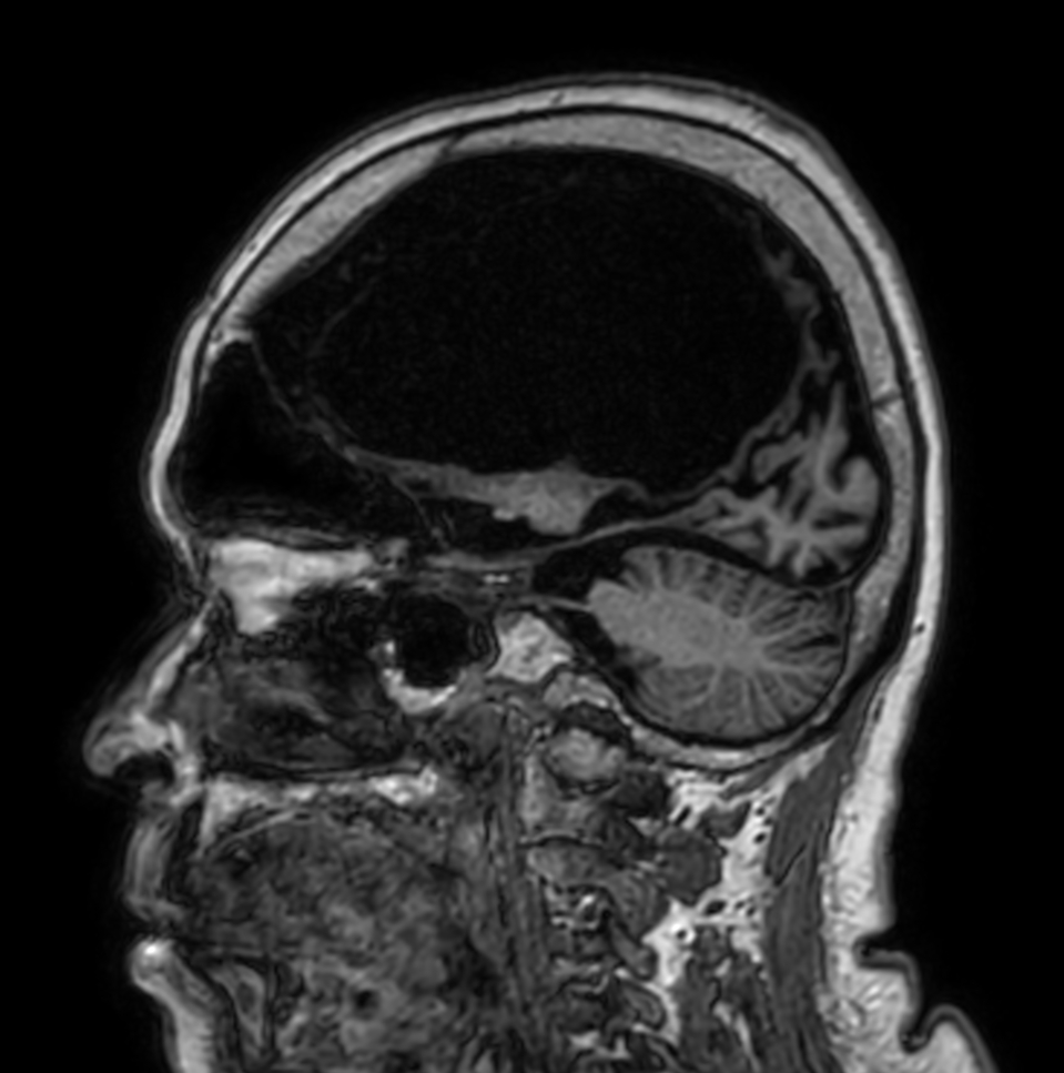Sagittal T1w 3D TFE