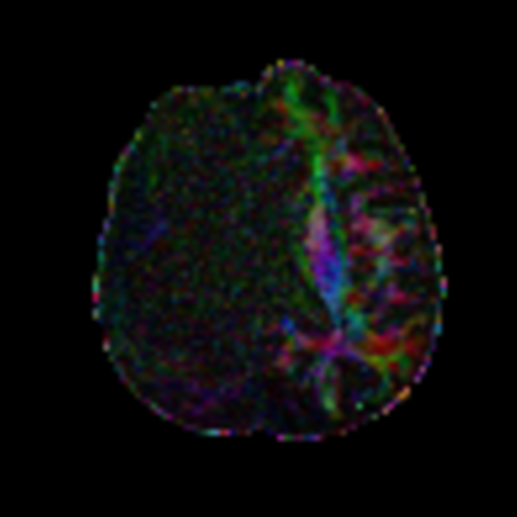 Axial DTI FiberTrak (32 directions)