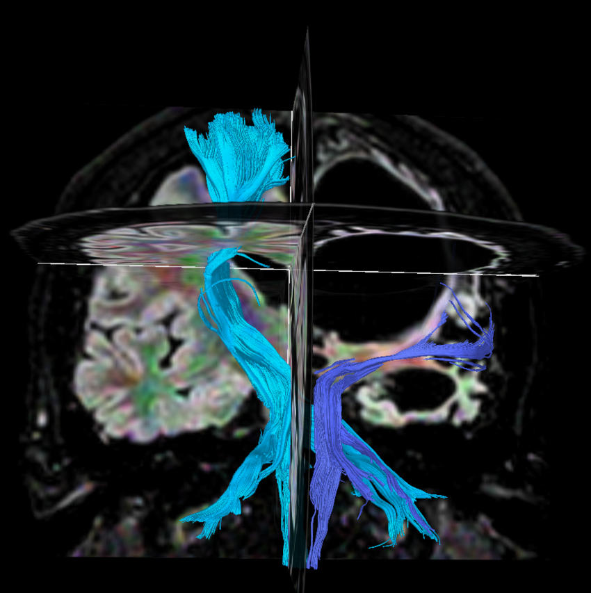 DTI FiberTrak (32 directions)