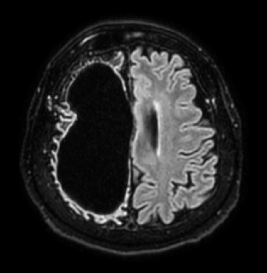 Axial 3D BrainVIEW FLAIR (without Compressed SENSE)