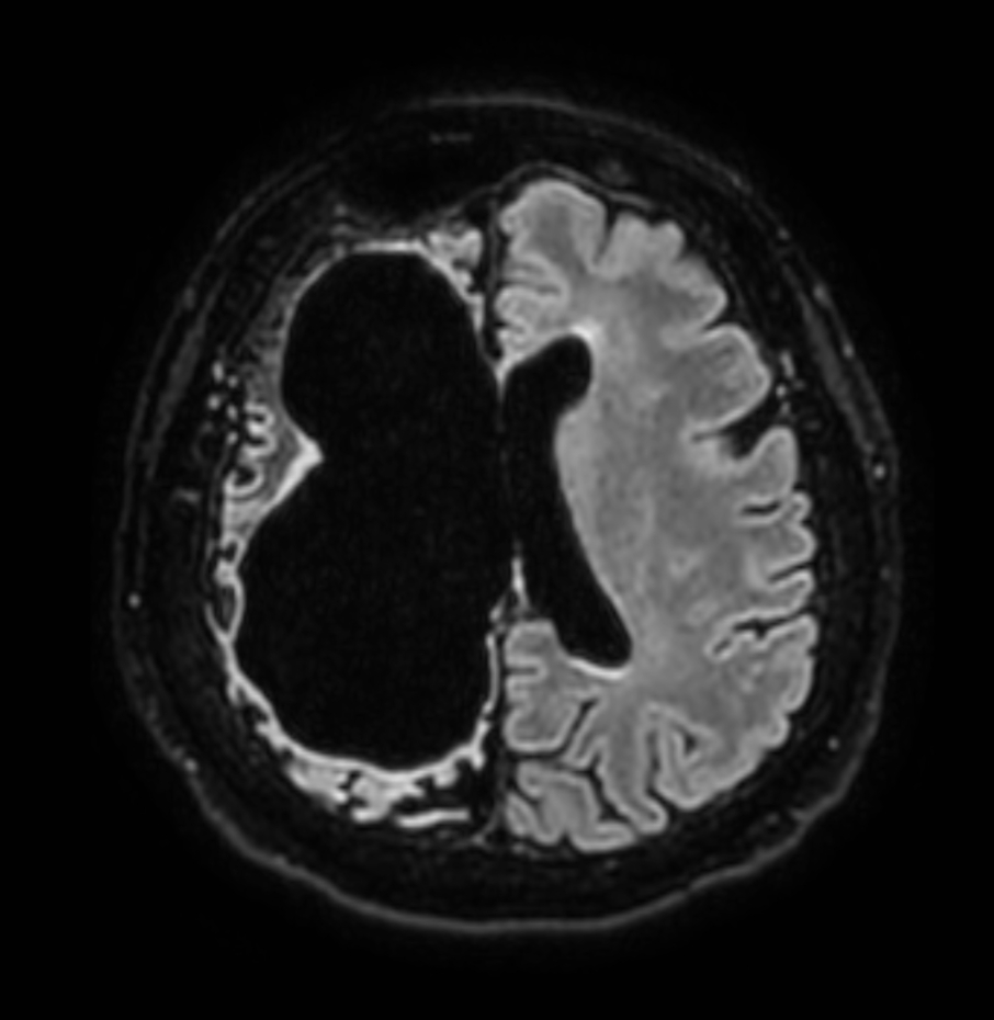 Axial 3D BrainVIEW FLAIR (Compressed SENSE)